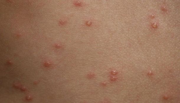 Alerta en la Ciudad: una mujer y un hombre murieron por sarampión y dengue