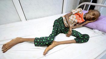 Saida Ahmad Baghili internada en un hospital de Yemen con desnutrición aguda Saida Ahmad Baghili internada en un hospital de Yemen con desnutrición aguda
