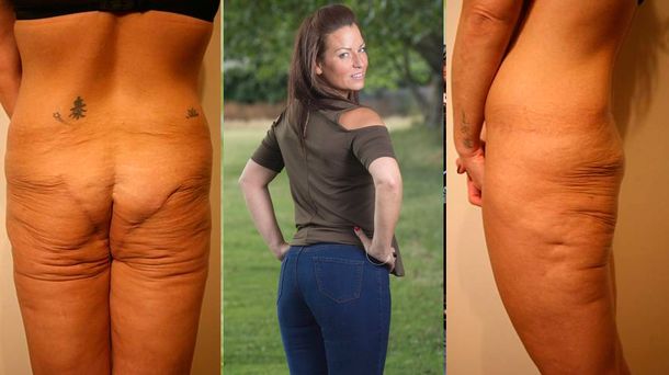 Una mujer se quedó sin cola tras sufrir una mala praxis en la cirugía estética