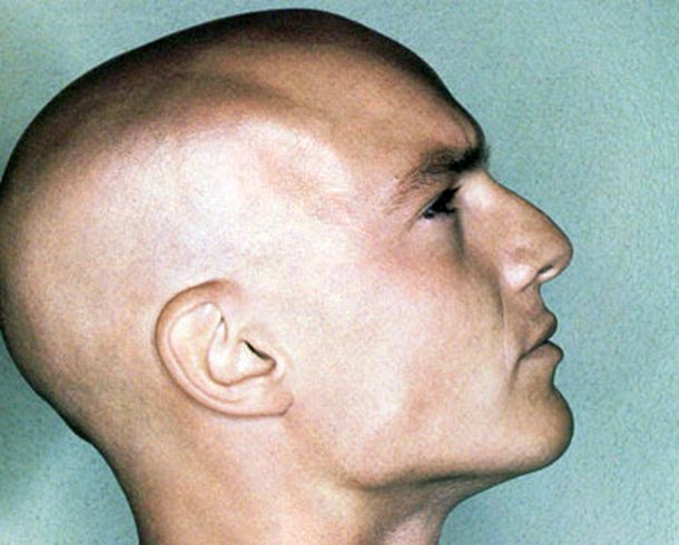 Un medicamento contra la artritis podría ser la clave para solucionar la calvicie