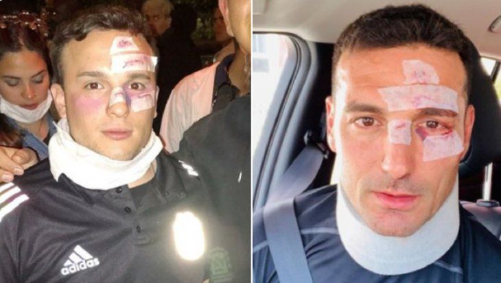 Se disfrazó de Lionel Scaloni accidentado y es viral