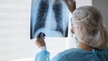 Alerta por fuerte aumento de casos de tuberculosis en Argentina: subieron un 80% en 5 años