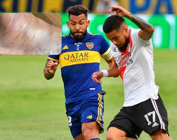 ¿Cómo Diego en el 90? Impactante imagen del tobillo de Tevez tras el Superclásico