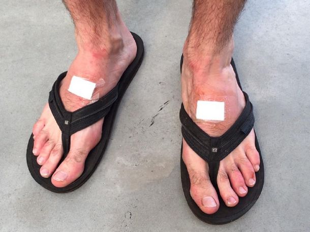 Tras la batalla ante Souza, así están hoy los pies de Leonardo Mayer