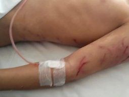 Salvaje ataque de una jauría a un nene de 9 años