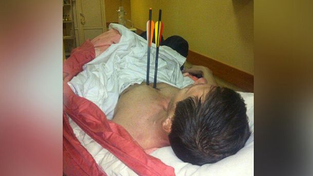 Un hombre se clavó dos flechas en su cuerpo y sobrevivió.&nbsp;