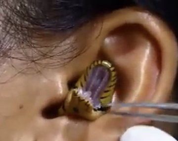 Un cirujano intenta sacar una serpiente viva de la oreja de una mujer