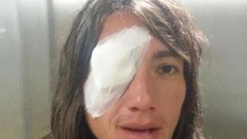 por la pedrada, lugüercio sufrio una ulcera de cornea en su ojo derecho por la pedrada, lugüercio sufrio una ulcera de cornea en su ojo derecho