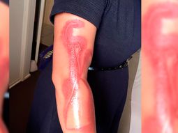 Una mujer asegura que el iPhone le generó quemaduras de segundo grado Una mujer asegura que el iPhone le generó quemaduras de segundo grado
