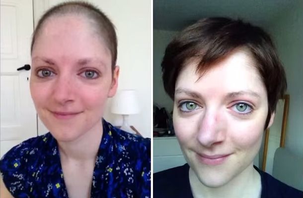 VIDEO: Muestra la recuperación de su pelo post quimio con una foto diaria
