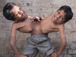 son siameses y se niegan a ser separados porque en su pais los adoran como dioses son siameses y se niegan a ser separados porque en su pais los adoran como dioses