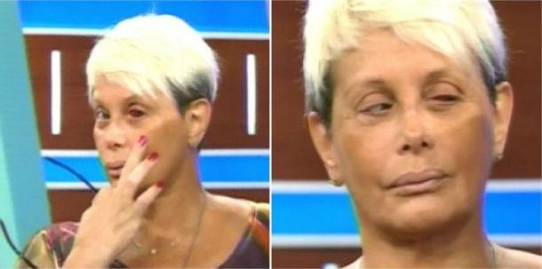 ¿Qué le pasó en el ojo a Carmen Barbieri?