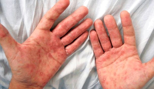 Preocupación en la comunidad médica por el aumento de sífilis Preocupación en la comunidad médica por el aumento de sífilis