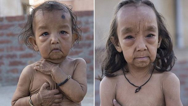 Dos niños sufren la enfermedad de Benjamin Button