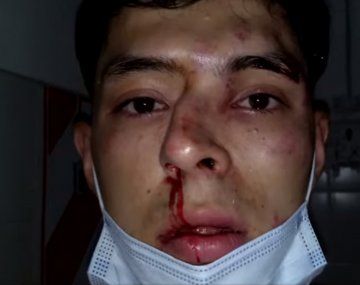 Chaco: le rompieron el tabique por defender a una amiga