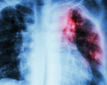 La UBA desarrolla una estrategia innovadora contra la Tuberculosis&nbsp;
