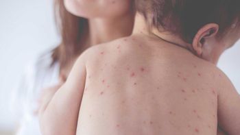 alerta sanitaria por sarampion: cuales son sus sintomas y como prevenirlo alerta sanitaria por sarampion: cuales son sus sintomas y como prevenirlo