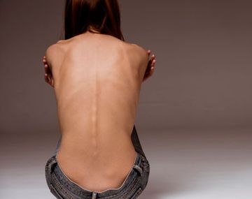 Trastornos alimenticios: es la tercera enfermedad crónica más común entre las jóvenes