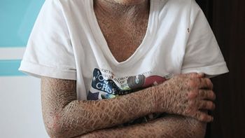 conmueve a china el extrano caso del nino pez conmueve a china el extrano caso del nino pez