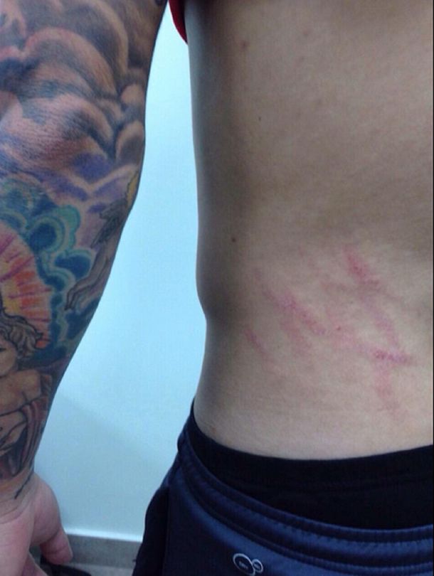 Mirá cómo quedó la espalda de Aránguiz tras la brutal patada de Zambrano