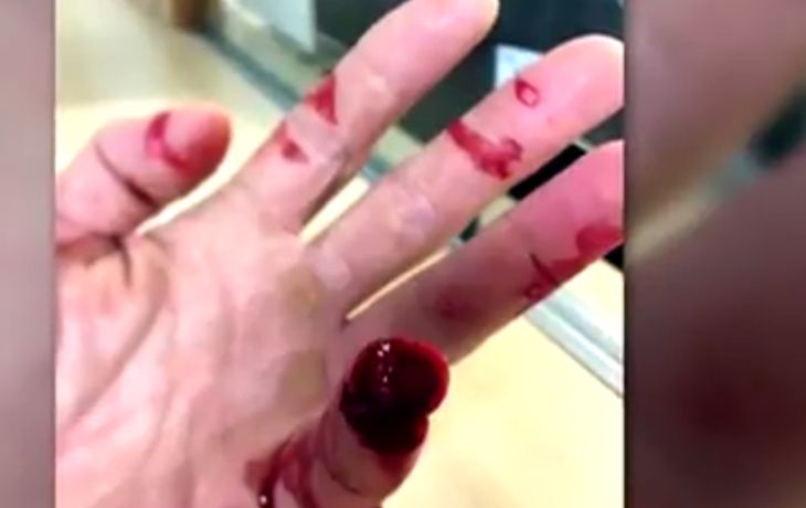 Un policía perdió un dedo por un mordisco durante una detención Un policía perdió un dedo por un mordisco durante una detención