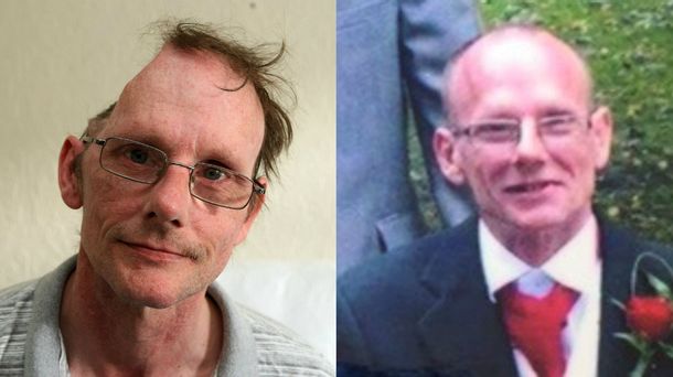 A este hombre le falta la mitad del cráneo, pero no califica como discapacitado