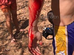 Un adolescente es atacado por un cocodrilo Un adolescente es atacado por un cocodrilo