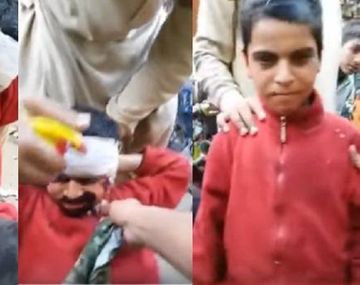 Nene se hacía pasar como quemado