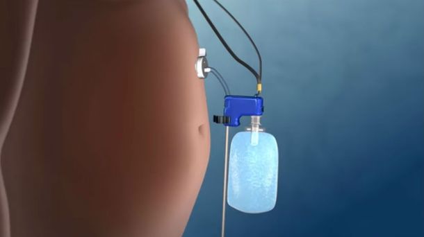 Llega un nuevo tratamiento para la obesidad: aspira la comida ya ingerida