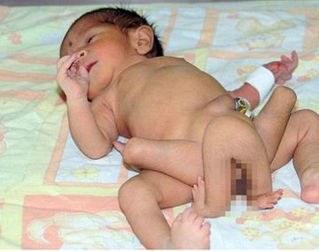 Bebé de 6 piernas
