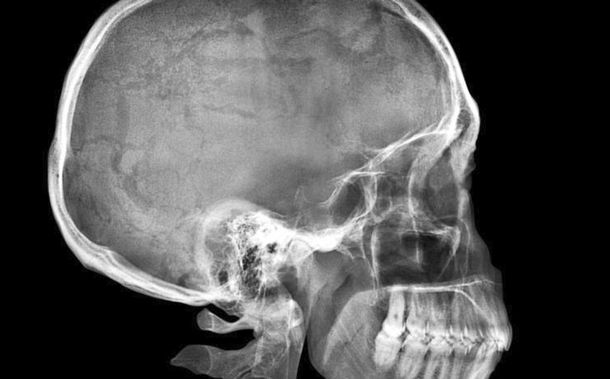 Fue al hospital por dolores de cabeza y le hallaron una bala en el cráneo