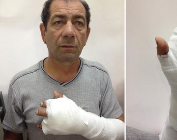 Se cortó los dedos con una amoladora y lograron reconstruirle la mano