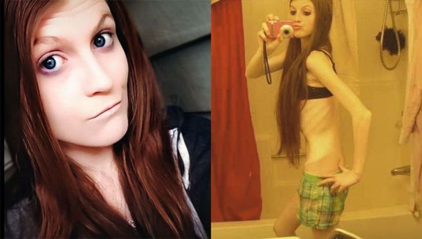 Dos hermanas compitieron para ver quién adelgazaba más rápido y ahora luchan por su vida