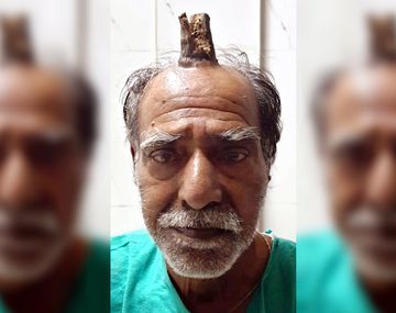 Shyam Lal Yadav tenía un cuerno de 10 centímetros en su cabeza