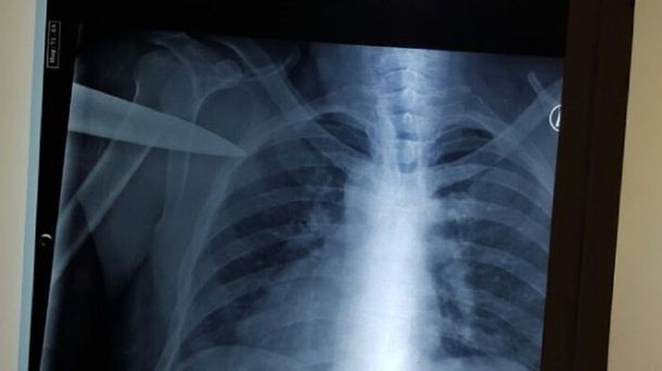 Un hombre manejó con un cuchillo clavado en su espalda