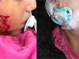 Brutal ataque de un perro a una nena de 2 años: Me parte el corazón la falta de empatía