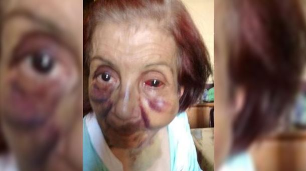 Brutal golpiza a una anciana discapacitada en un geriátrico de Mendoza