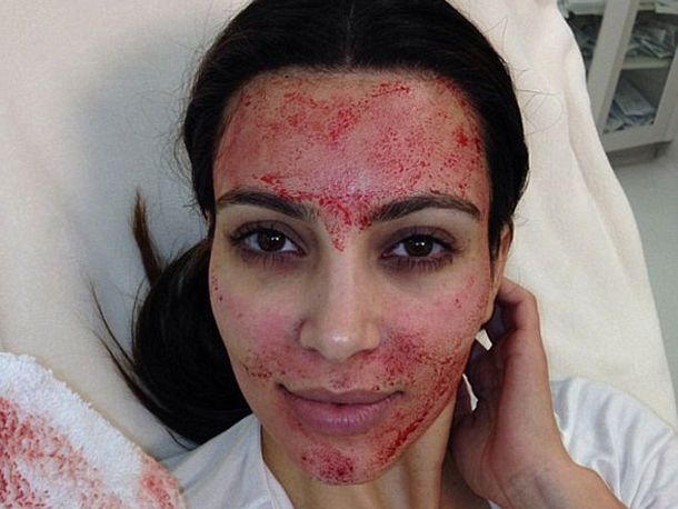 Kim Kardashian se somete a un asqueroso tratamiento de belleza