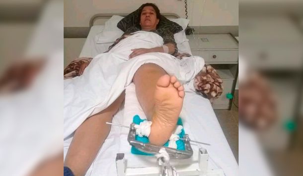 La mujer está internada con una fractura en la pierna izquierda