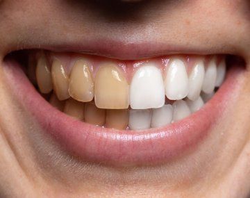 El truco casero para blanquear tus dientes rápido y fácil