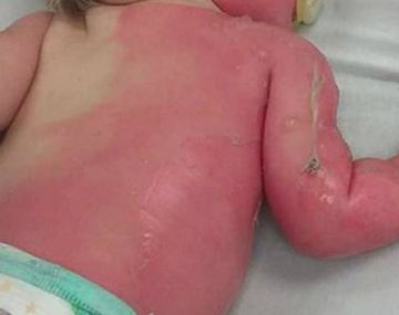 Una mamá roció a su bebé con agua hirviendo