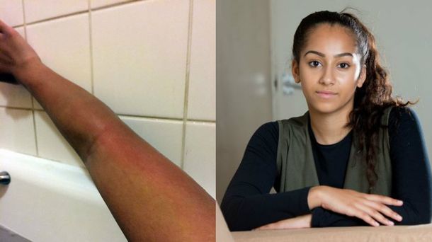 Una adolescente es alérgica al agua, por lo que no puede bañarse sin dolor