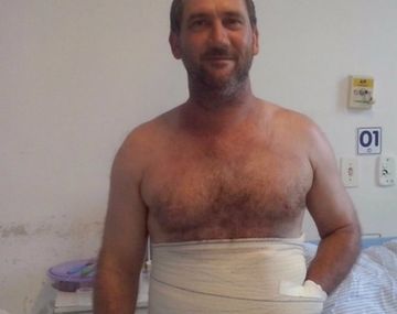 Le abrieron un bolsillo en el abdomen