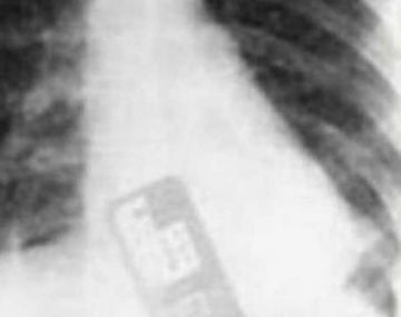 Dejó su celular en el vientre de una paciente