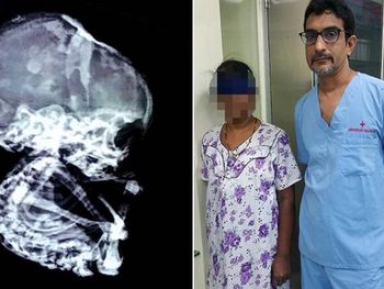 El extraño caso de la mujer que vivió con un feto petrificado durante 15 años