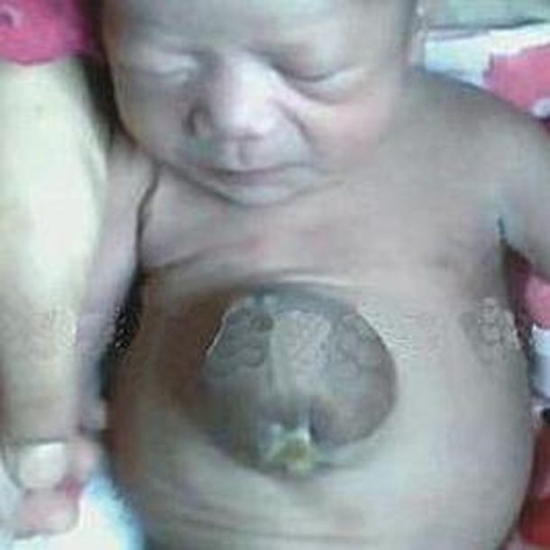 Nació un bebé con el corazón en el estómago