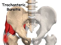 que es la bursitis trocanterea que le diagnosticaron a la presidenta cristina kirchner que es la bursitis trocanterea que le diagnosticaron a la presidenta cristina kirchner