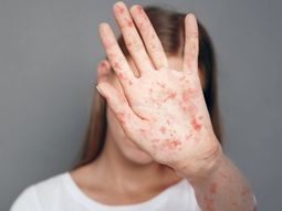 Sarampión. Sarampión.