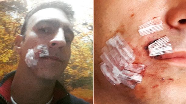 Luis Pavesio, desfigurado por un perro: Me faltaban pedazos de la cara