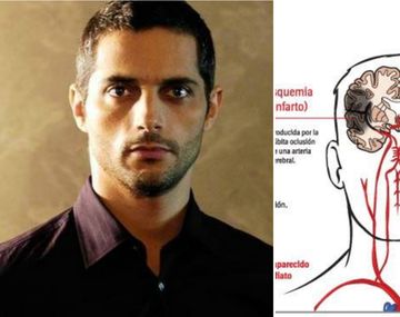 Qué es el infarto isquémico que tuvo Furriel